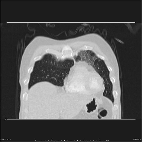 File:Atypical pneumonia - Q fever (Radiopaedia 21993-21989 C 5).jpg