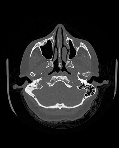 File:Automastoidectomy with labyrinthine fistula (Radiopaedia 84143-99411 Axial non-contrast 68).jpg