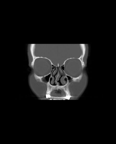File:Automastoidectomy with labyrinthine fistula (Radiopaedia 84143-99411 Coronal non-contrast 18).jpg