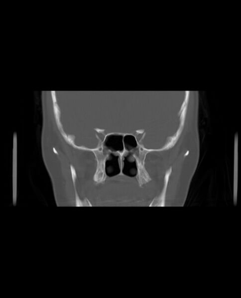 File:Automastoidectomy with labyrinthine fistula (Radiopaedia 84143-99411 Coronal non-contrast 55).jpg