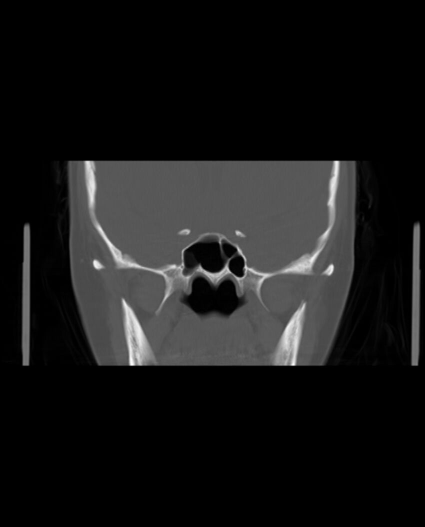 Automastoidectomy with labyrinthine fistula (Radiopaedia 84143-99411 Coronal non-contrast 65).jpg