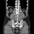 Autosomal dominant polycystic kidney disease (Radiopaedia 36539-38101 C 56).jpg