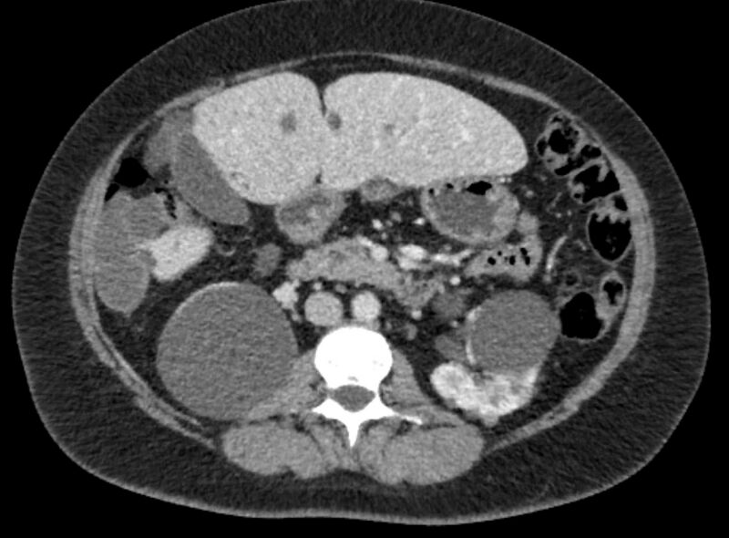 File:Autosomal dominant polycystic kidney disease (Radiopaedia 57124-64017 A 53).jpg