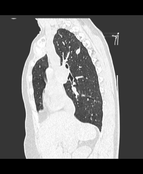 File:Azygos fissure and azygos lobe (Radiopaedia 41841-44832 Sagittal lung window 7).jpg