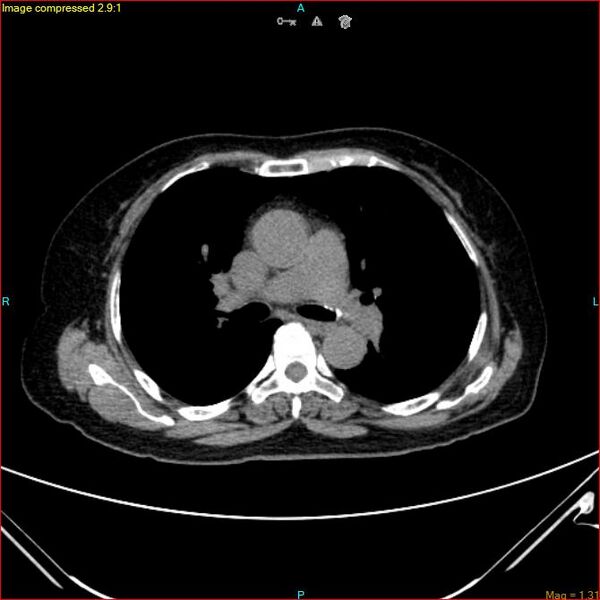 File:Azygos vein aneurysm (Radiopaedia 77824-90130 A 28).jpg
