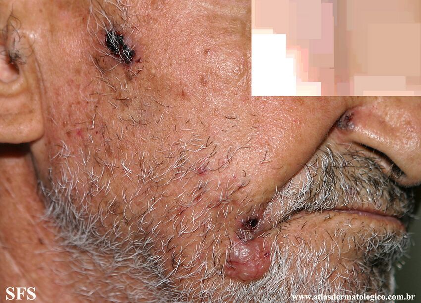 Basal Cell Carcinoma (Dermatology Atlas 309).jpg