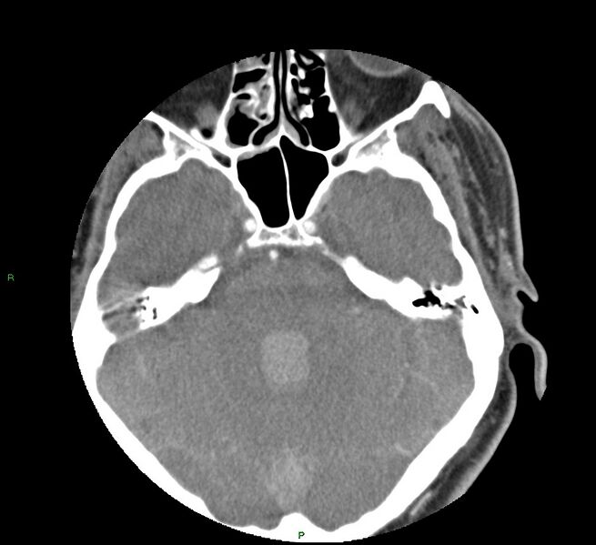 File:Basal ganglia hemorrhage (Radiopaedia 58763-65985 D 57).jpg