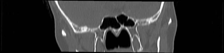 Basilar impression (Radiopaedia 52411-58522 Coronal bone window 20).jpg