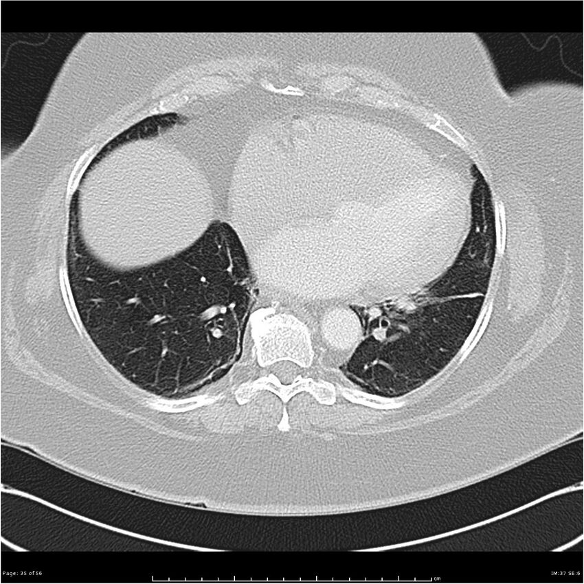 Benign metastasizing leiomyoma (Radiopaedia 26803-26962 Axial lung window 35).jpg
