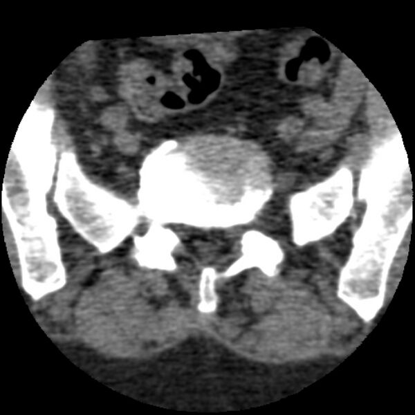 File:Bertolotti syndrome (Radiopaedia 24864-25128 Axial non-contrast 20).jpg