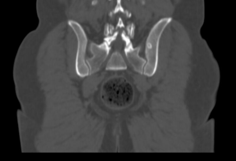 File:Bertolotti syndrome (Radiopaedia 58974-66235 Coronal bone window 9).jpg