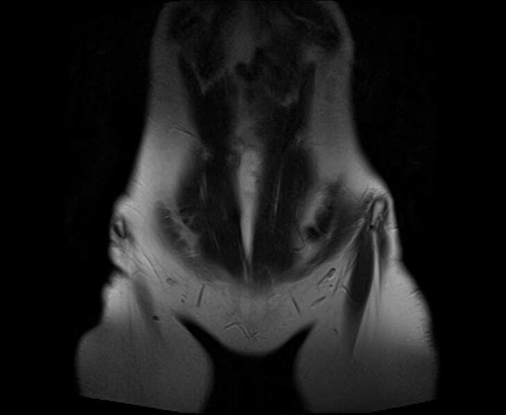 File:Bicornuate bicollis uterus (Radiopaedia 61626-69616 Coronal T2 2).jpg