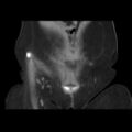 Bicornuate uterus- on MRI (Radiopaedia 49206-54296 Coronal non-contrast 1).jpg