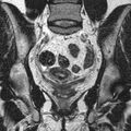 Bicornuate uterus (Radiopaedia 11104-11492 Coronal T2 14).jpg