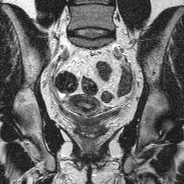 File:Bicornuate uterus (Radiopaedia 11104-11492 Coronal T2 14).jpg