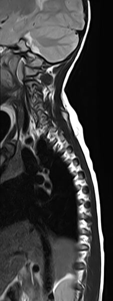 File:Bilateral Sprengel deformity with Klippel-Feil syndrome (Radiopaedia 66395-75650 Sagittal T2 2).jpg