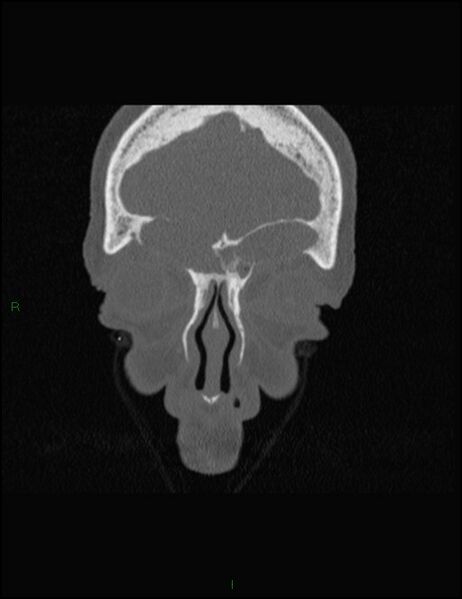 File:Bilateral frontal mucoceles (Radiopaedia 82352-96454 Coronal 71).jpg