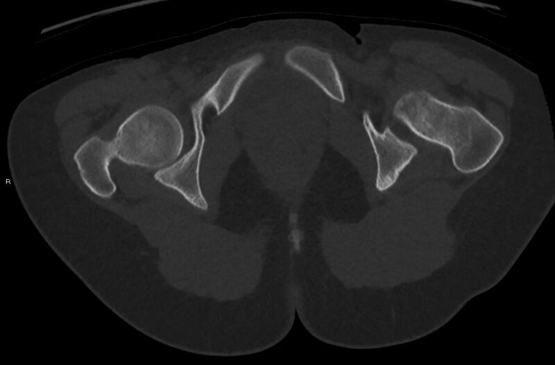 File:Bilateral mature cystic ovarian teratoma (Radiopaedia 88821-105592 Axial bone window 59).jpg