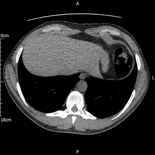 File:Bilateral medullary nephrocalcinosis with ureteric calculi (Radiopaedia 71269-81569 Axial non-contrast 1).jpg