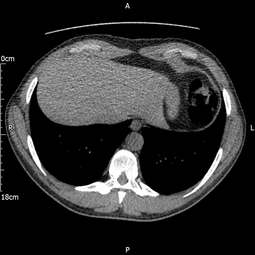 Bilateral medullary nephrocalcinosis with ureteric calculi (Radiopaedia 71269-81569 Axial non-contrast 1).jpg