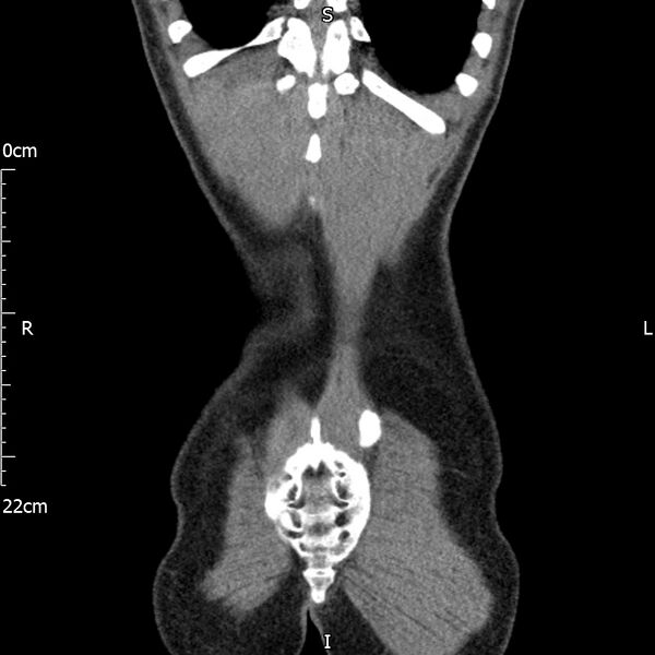File:Bilateral medullary nephrocalcinosis with ureteric calculi (Radiopaedia 71269-81569 Coronal non-contrast 69).jpg