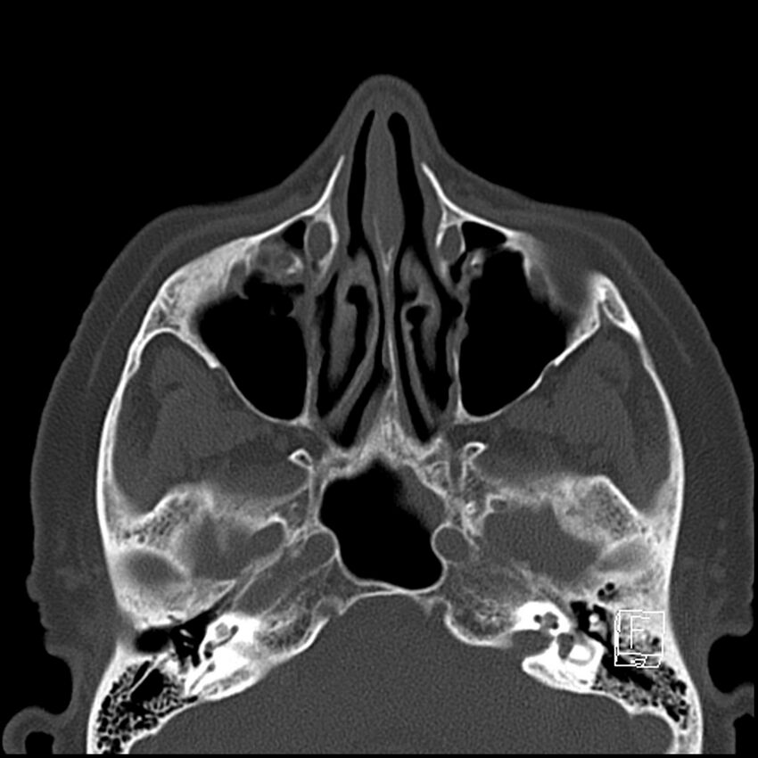 Bilateral palatine tonsilloliths on OPG and CT (Radiopaedia 75167-86247 Axial bone window 17).jpg
