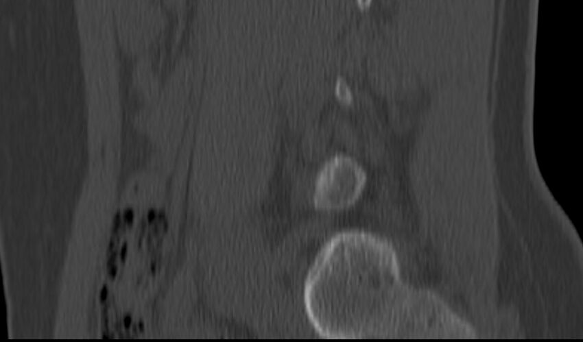 Bilateral pars defect (Radiopaedia 26691-26846 Sagittal bone window 16).jpg