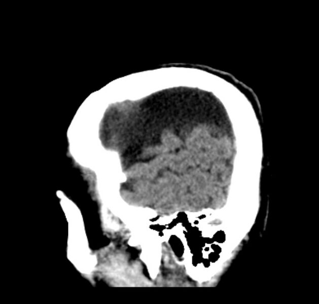 File:Bilateral subdural hygromata (Radiopaedia 29245-29656 C 8).jpg