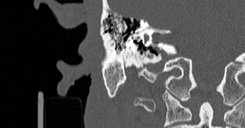 File:Bilateral temporal bone fractures (Radiopaedia 29482-29970 Coronal non-contrast 120).jpg
