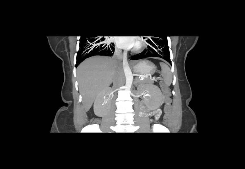 File:Bilateral urolithiasis with incidentally detected splenic artery aneurysm and left inferior vena cava (Radiopaedia 44467-48127 Coronal MIP 1).jpg