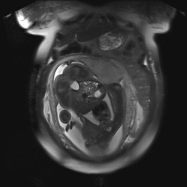 File:Bilobed placenta accreta (Radiopaedia 69648-79591 Coronal T2 fat sat 12).jpg