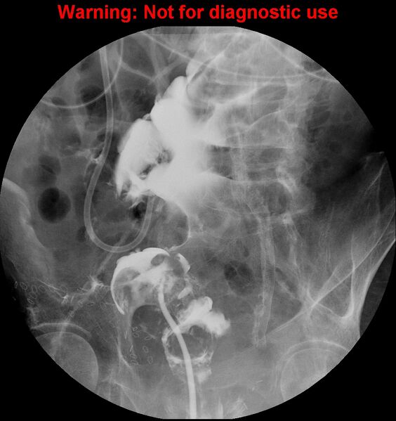 File:Bladder rupture (intraperitoneal) (Radiopaedia 41057-43807 cystogram 8).jpg