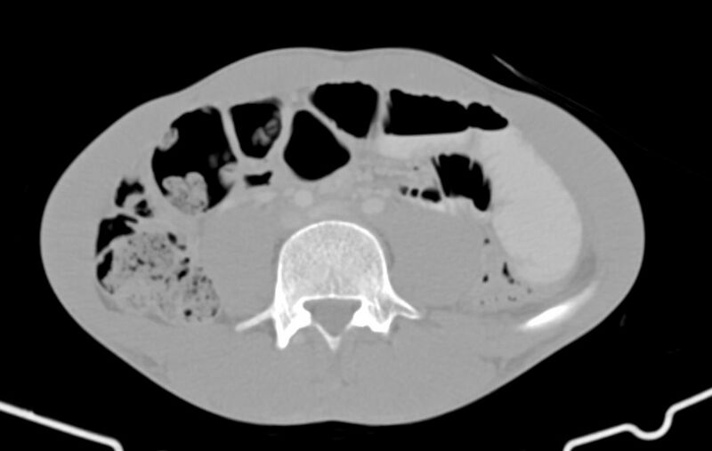 File:Blunt injury to the small bowel (Radiopaedia 74953-85987 Axial Wide 58).jpg
