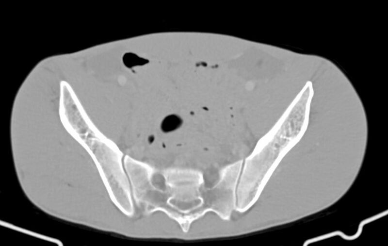 File:Blunt injury to the small bowel (Radiopaedia 74953-85987 Axial Wide 79).jpg