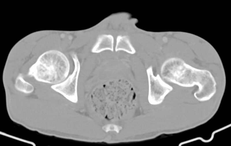 File:Blunt injury to the small bowel (Radiopaedia 74953-85987 Axial Wide 96).jpg