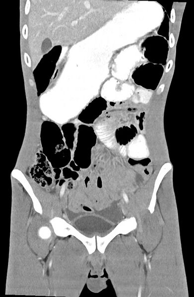 File:Blunt injury to the small bowel (Radiopaedia 74953-85987 B 34).jpg