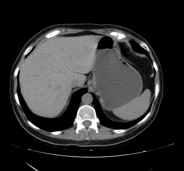 File:Bosniak renal cyst - type IV (Radiopaedia 22929-22953 Axial non-contrast 8).jpg
