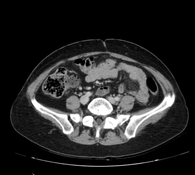 File:Bosniak renal cyst - type IV (Radiopaedia 22929-22953 C 44).jpg