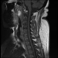 Brachial plexopathy (Radiopaedia 21844-21806 Sagittal T1 C+ 5).jpg