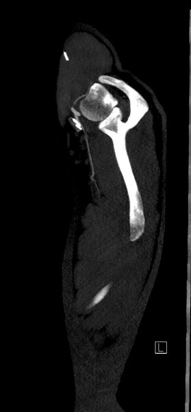 File:Brachiocephalic trunk pseudoaneurysm (Radiopaedia 70978-81191 C 2).jpg