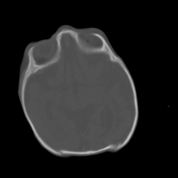 File:Brachycephaly (bi-coronal and bi-lambdoid synostosis) (Radiopaedia 55048-61413 Axial bone window 6).jpg