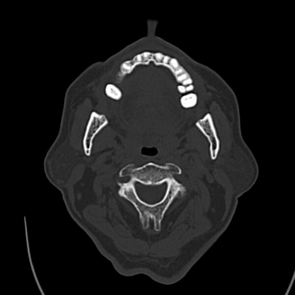 File:Brain Pantopaque remnants (Radiopaedia 78403-91048 Axial bone window 1).jpg