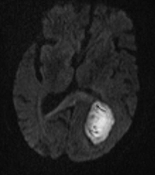 File:Brain abscess with dual rim sign (Radiopaedia 87566-103938 Axial DWI 10).jpg
