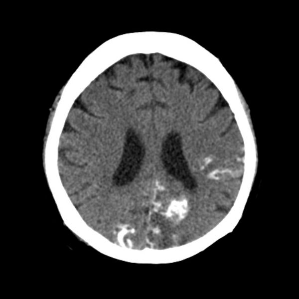 File:Brain cortical laminar necrosis (Radiopaedia 25822-25971 Axial non-contrast 29).jpg