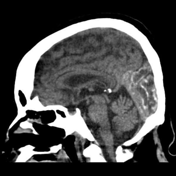 File:Brain cortical laminar necrosis (Radiopaedia 25822-25971 non-contrast 26).jpg