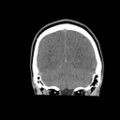 Brain death (Radiopaedia 78597-91360 Coronal non-contrast 58).jpg