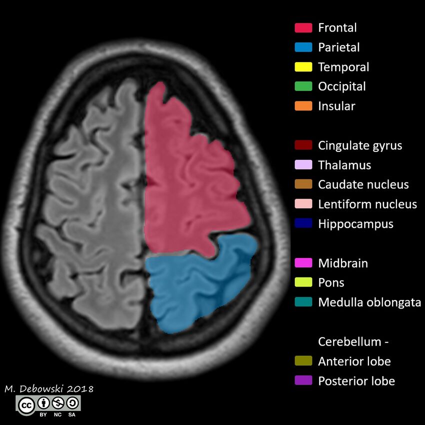 Brain lobes - annotated MRI (Radiopaedia 61691-69700 Axial 13).JPG