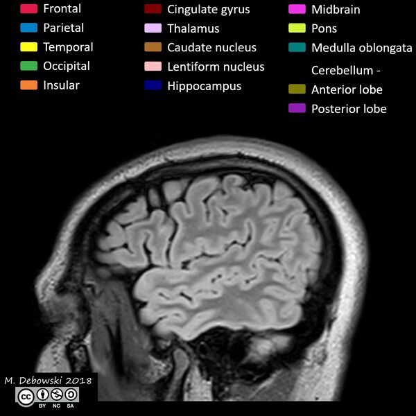 File:Brain lobes - annotated MRI (Radiopaedia 61691-69700 Sagittal 9).JPG