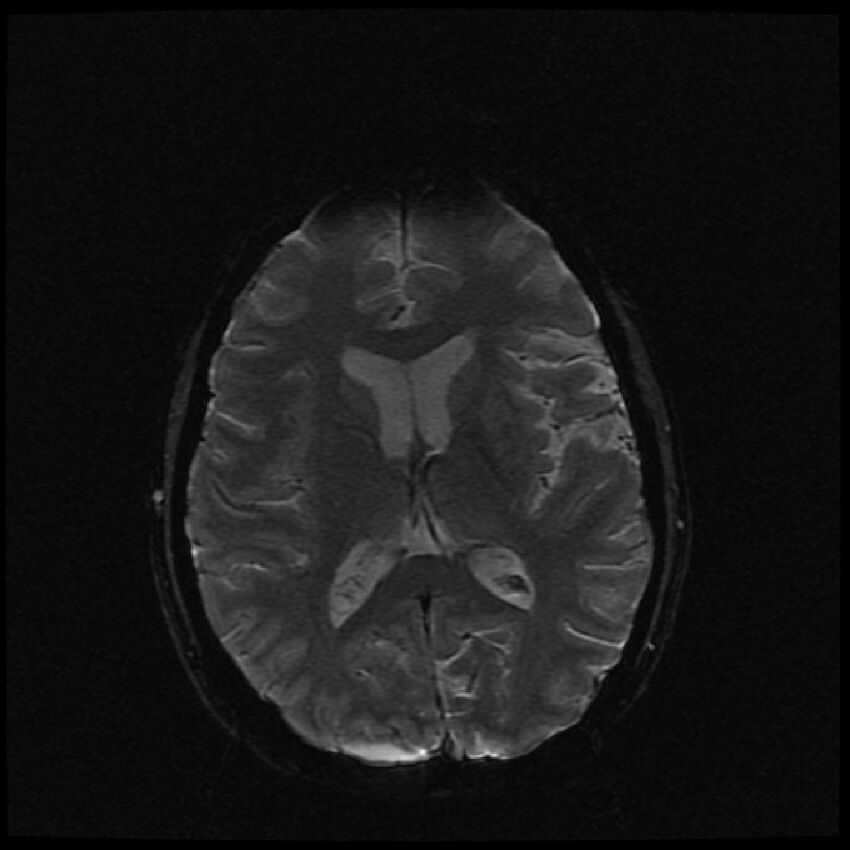 Brain metastases (renal cell carcinoma) (Radiopaedia 42571-45704 Axial SWI 27).jpg