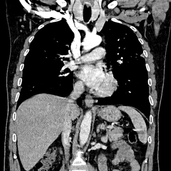 File:Brain metastases - lung cancer primary (Radiopaedia 75060-86116 C+ arterial phase 32).jpg